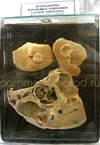  Печень коровы, поражённой личиночной стадией эхинококка. Зоологический музей, СПб 