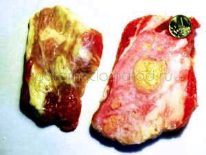  примерный вид последствий заражения трихинеллой -- воспалённый лимфоузел с лимфопротоками в куске обыкновенной говядины из обыкновенного мясного ларька, прошедший обыкновенный госветконтроль 
